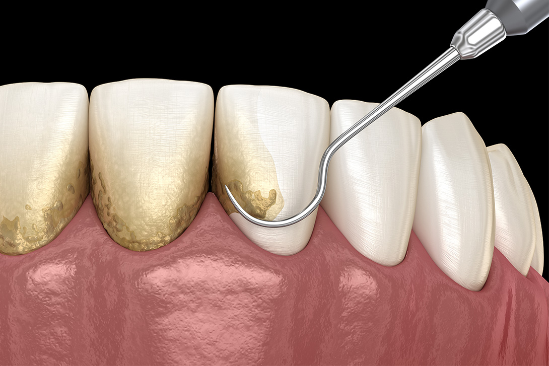 スケーリング｜つくばのたか歯科ファミリークリニック