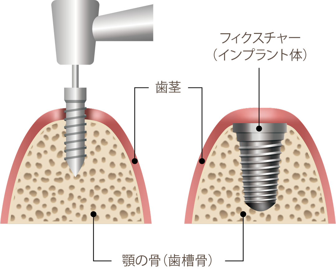 インプラント1次手術｜つくば台たか歯科ファミリークリニック