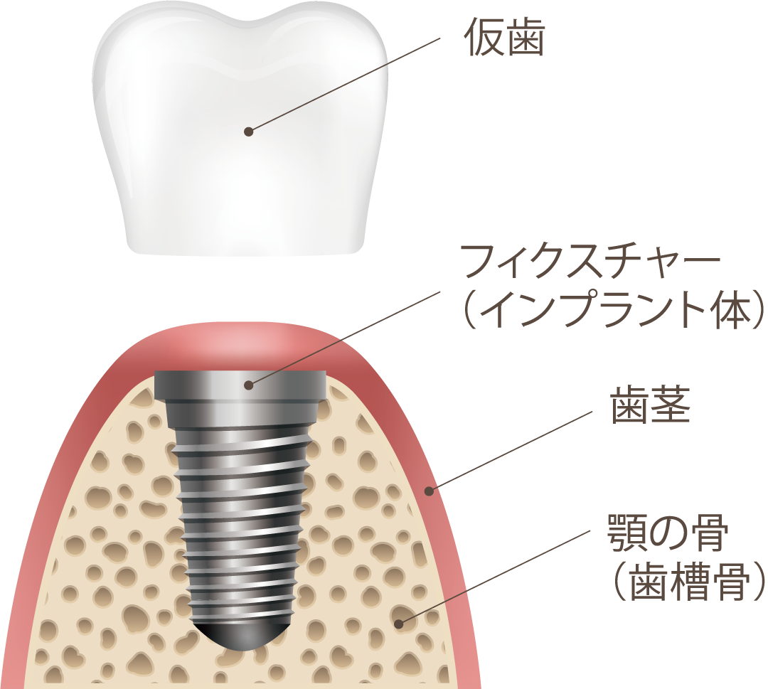 インプラント手術治癒時間｜つくば台たか歯科ファミリークリニック