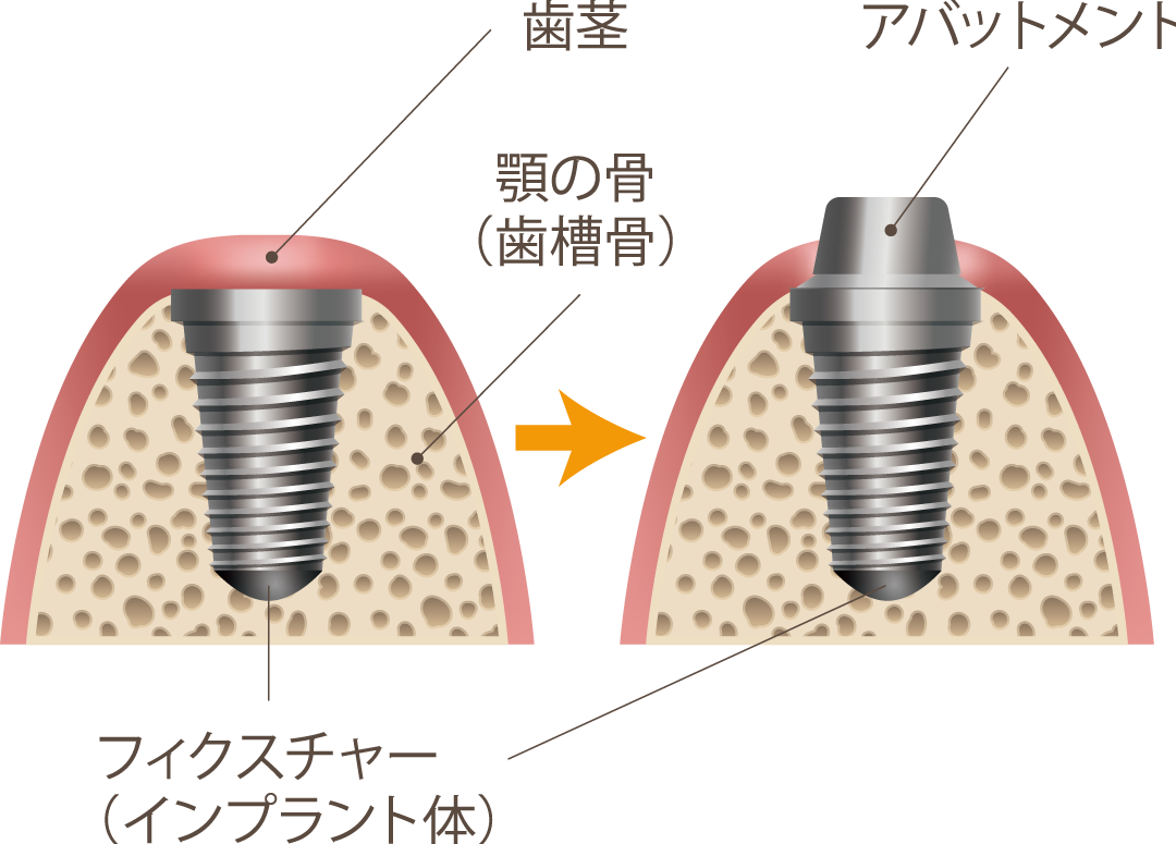インプラント2次手術｜つくば台たか歯科ファミリークリニック